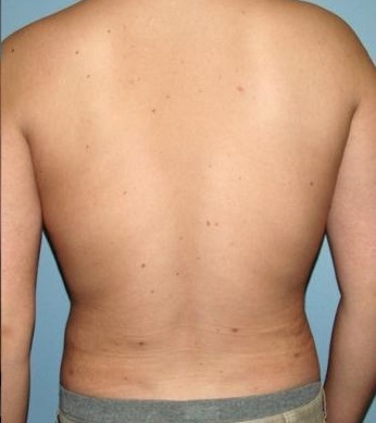 Biologická liposukce - boky